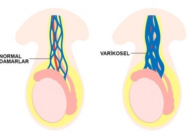 Varikosel: Nedir, Neden Olur, Belirtileri ve Kısırlıkla İlişkisi