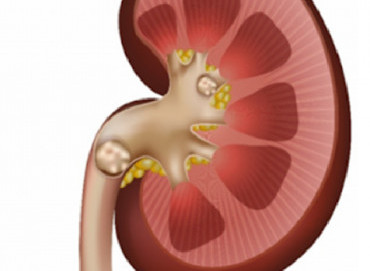 Böbrek taşları için lazer tedavisi nasıl uygulanır?