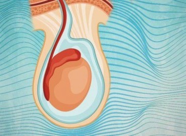Hidrosel (Testis Torbasında Sıvı Birikmesi): Nedir, Neden Olur, Belirtileri ve Tedavi Yöntemleri