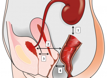 İdrar Yolu Enfeksiyonlarında Bağırsak Mikrobiyomunun Rolü Nedir?