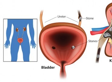 Böbrek taşlarının oluşumu ve önlenmesi için diyet önerileri