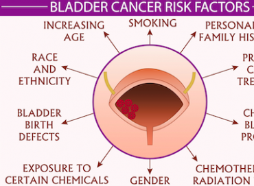 Mesane kanseri belirtileri ve risk faktörleri nelerdir?