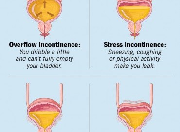 Kadınlarda idrar kaçırma sorunu ve tedavi yöntemleri