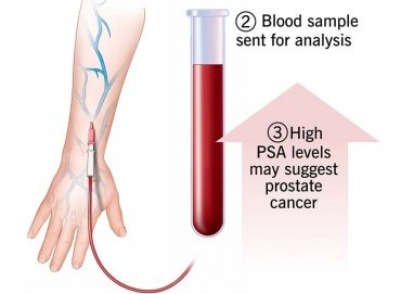 Prostat kanseri taramasında PSA testi ne kadar güvenilir?
