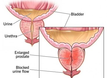Prostat büyümesi için ilaç tedavisi mi, cerrahi mi?