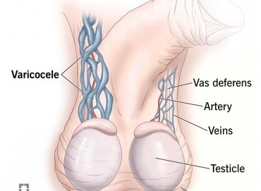 Erkeklerde varikosel: Kısırlıkla ilişkisi ve tedavisi
