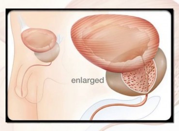 Prostat büyümesi (BPH) belirtileri ve erken teşhis yöntemleri