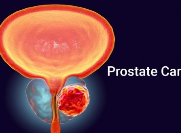 Prostat kanseri sonrası cinsel sağlık ve iyileşme süreci