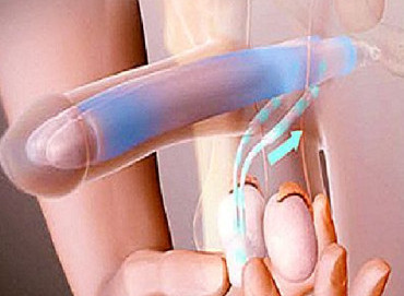 Erkeklerde sertleşme sorunu (erektil disfonksiyon) ve modern tedaviler