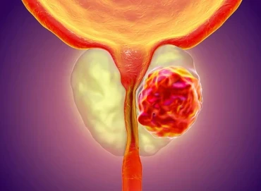 Prostat muayenesi neden korkulacak bir şey değil?