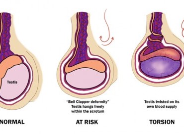 Testis Torsiyonu: Acil Ürolojik Durumun Belirtileri ve Tedavisi
