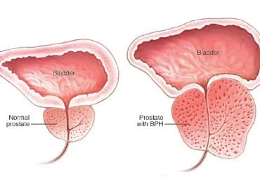 Prostat Büyümesi (BPH): Nedir, Neden Olur, Belirtileri ve Tedavi Yöntemleri