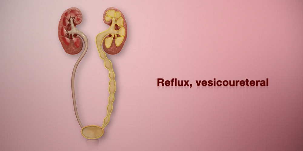 Çocuklarda böbrek reflüsü (VUR) ve tedavi seçenekleri