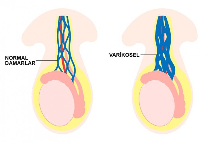 Varikosel: Nedir, Neden Olur, Belirtileri ve Kısırlıkla İlişkisi