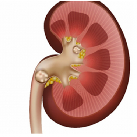 Böbrek taşları için lazer tedavisi nasıl uygulanır?