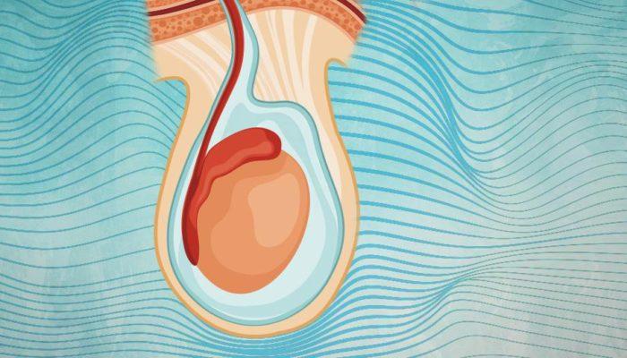 Hidrosel (Testis Torbasında Sıvı Birikmesi): Nedir, Neden Olur, Belirtileri ve Tedavi Yöntemleri