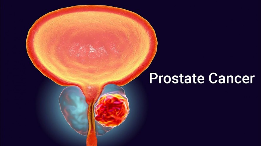 Prostat kanseri sonrası cinsel sağlık ve iyileşme süreci