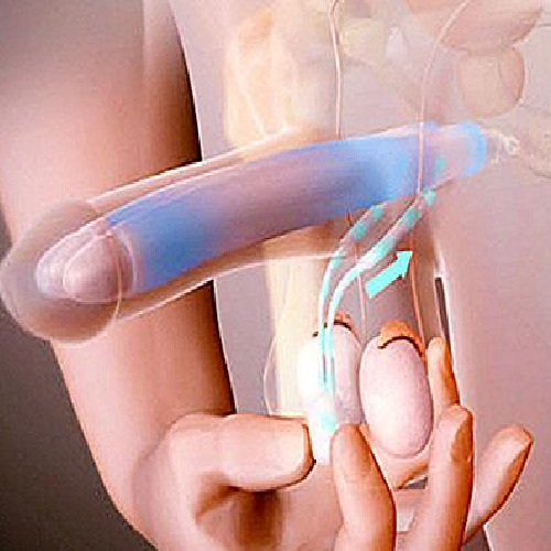 Erkeklerde sertleşme sorunu (erektil disfonksiyon) ve modern tedaviler