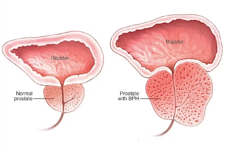 Prostat Büyümesi (BPH): Nedir, Neden Olur, Belirtileri ve Tedavi Yöntemleri