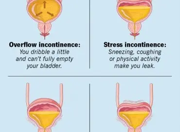 Kadınlarda idrar kaçırma sorunu ve tedavi yöntemleri