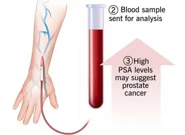 Prostat kanseri taramasında PSA testi ne kadar güvenilir?