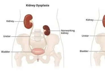 Böbrek sağlığını korumak için günlük hayatta yapılabilecekler