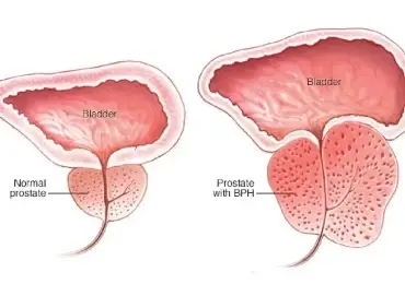 Prostat Büyümesi (BPH): Nedir, Neden Olur, Belirtileri ve Tedavi Yöntemleri